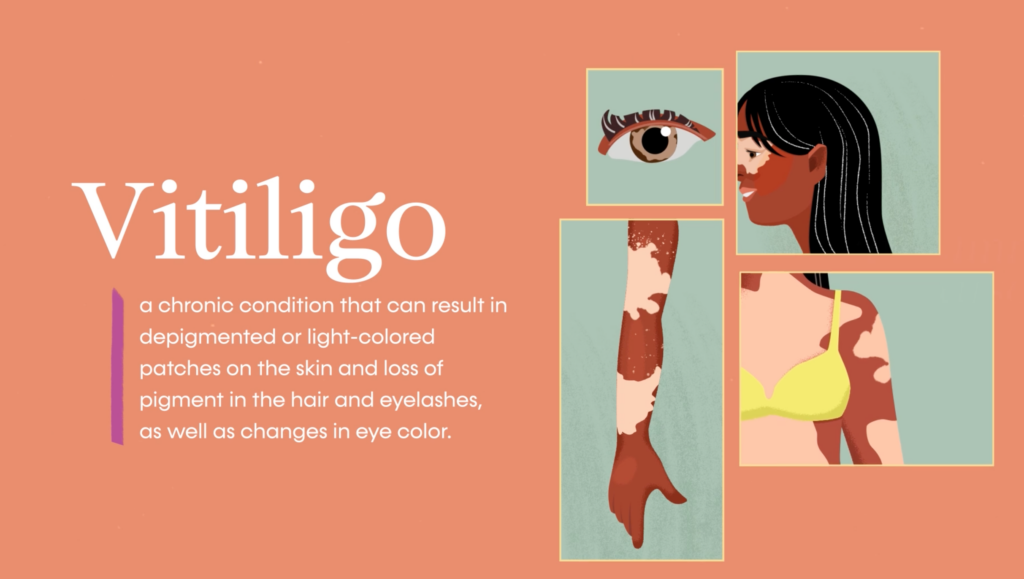 Vitiligo Video Marketing Campaign In Partnership With CondeNast